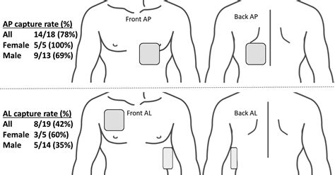 Anteroposterior Pacer Pad Position Is More Likely to Capture Than ...