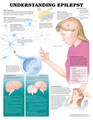 Understanding Epilepsy Poster | Epilepsy Anatomical Chart Company