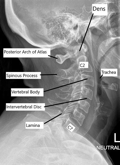 Anatomy of the Spine - Complete Orthopedics & Podiatry | Multiple NY ...