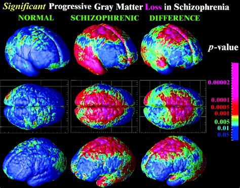 schizophrenia brain scans Quotes