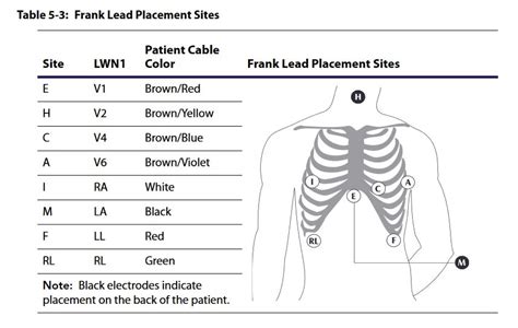 [DIAGRAM] Standard 12 Lead Ecg Placement Diagram - MYDIAGRAM.ONLINE