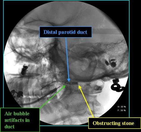 Sialolithiasis - Radiology | Iowa Head and Neck Protocols