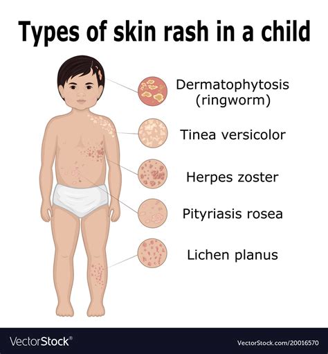 Understanding Rash In 3 Minutes Skin Rash Types And Causes – NBKomputer