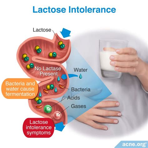 Does Lactose Intolerance Relate to Acne? - Acne.org