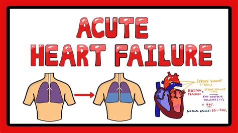 Acute Heart Failure - Types of Acute Heart Failure | Causes | Signs and ...