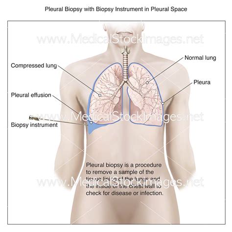 Pleural Biopsy with Instrument in Pleural Space – Medical Stock Images ...