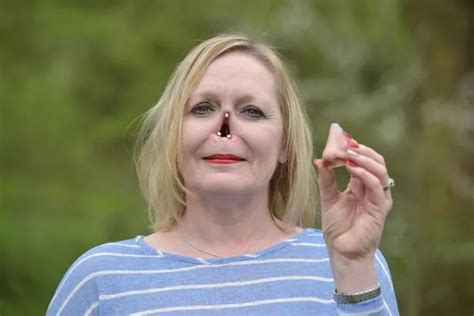 Mum whose nose rotted away has prosthetic attached to face using ...