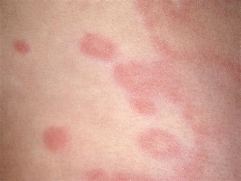 Childhood rashes and skin conditions - BabyCenter Canada