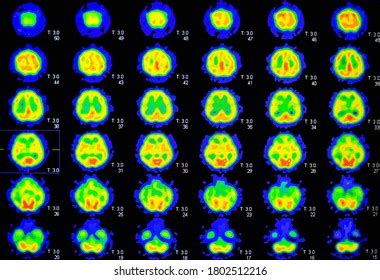 Pet Ct Scan Human Brain Axial Stock Photo 1802512216 | Shutterstock