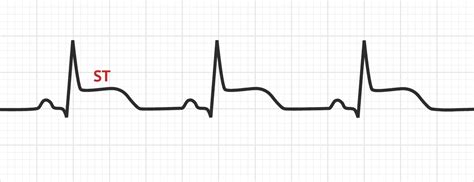 The ST Segment | ECG Basics - MedSchool