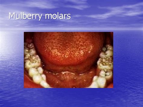 Mulberry molars and Hutchinsons incisor Milana Abayev D