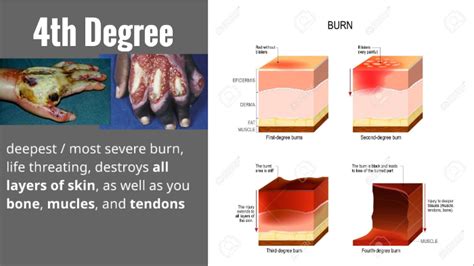 1st, 2nd, 3rd, 4th Degree Burns by Alita Buck on Prezi