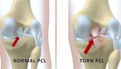 PCL Reconstruction Surgery in Chennai | PCL Reconstruction Surgery Cost ...