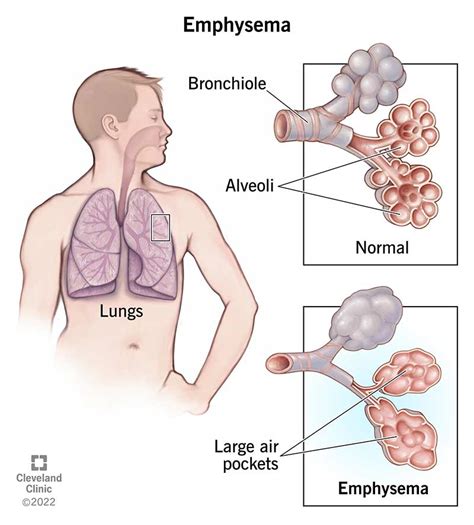 What is emphysema