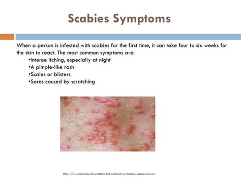 Common Scabies Symptoms