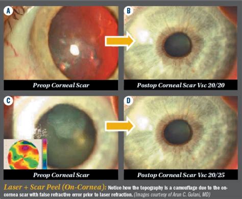 Corneal Scar Surgery Jacksonville | Gulani Vision