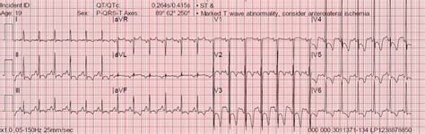 ECGs for EMS: LVH, Strain, Ischemia, or What?