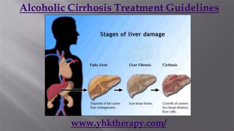 Alcoholic cirrhosis treatment guidelines