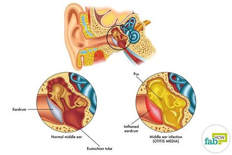 5 Home Remedies for Ear Infections (No.1 Provides Instant Relief)