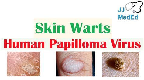 Types Of Warts And How To Treat Them A Visual Guide Allure, 58% OFF