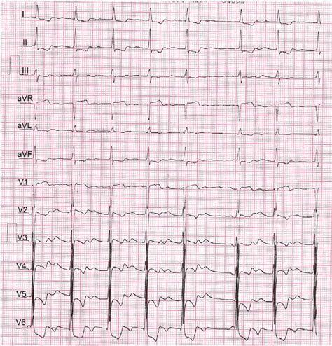 Atrial Fibrillation Ekg Pattern