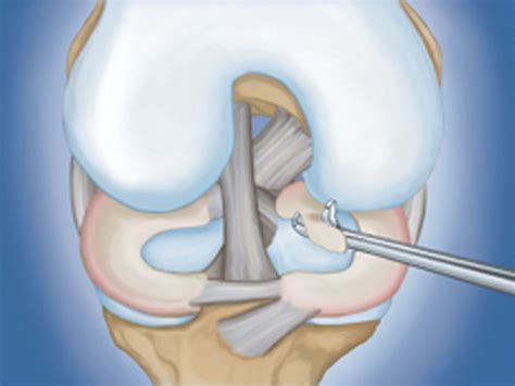 Meniscus tears and knee arthroscopic surgery - Welcome to Alosh Orthopedics