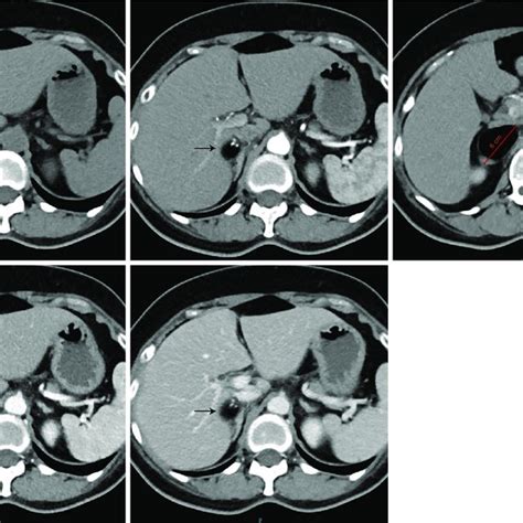 CT features of the mass in the right adrenal gland. CT scanning ...