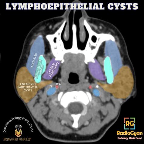 Benign Lymphoepithelial Cysts of the Parotid Gland | Radiology Case ...