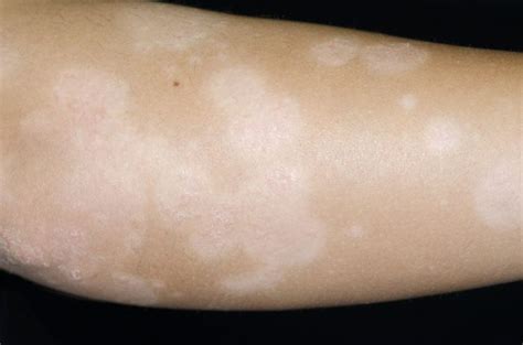 HYPOPIGMENTATION – Dermatology Conditions and Treatments