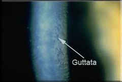 Cornea guttata refers to little areas of collagen that collect ...