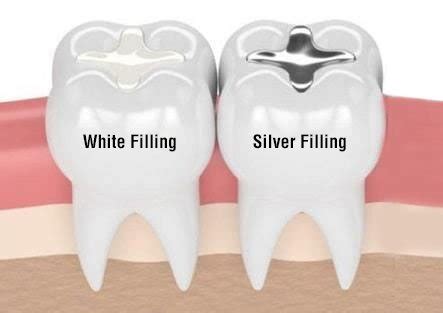 What is the Difference Between White Fillings and Silver Fillings - Resin