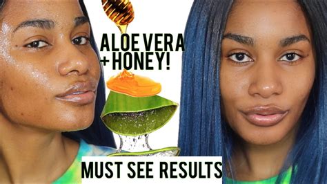 Does Aloe Vera Help Acne - All You Need Infos