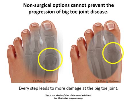 Big toe joint pain – limited/painful motion - HyProCure - The Proven ...