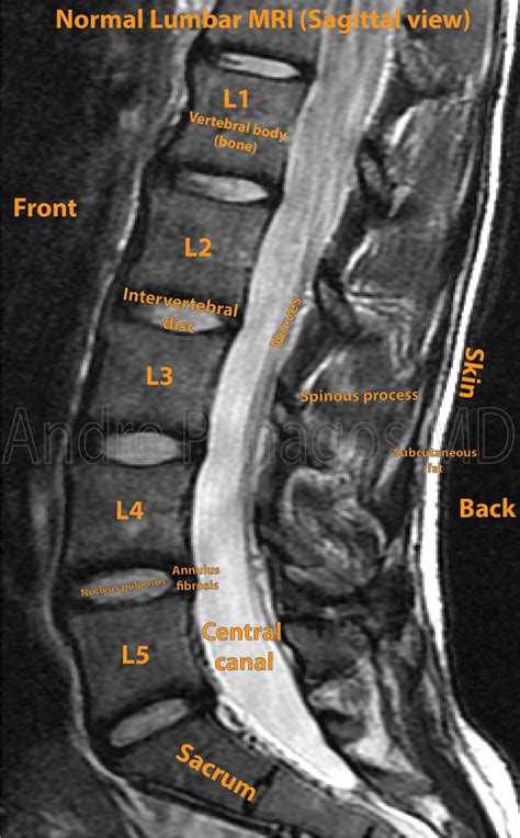 Mri Lumbar Spine Sagittal Cross Sectional Anatomy Anatomy Images Mri ...