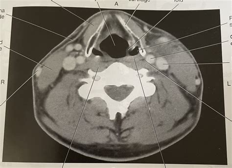 AXIAL CT OF LARYNGOPHARYNX** Diagram | Quizlet