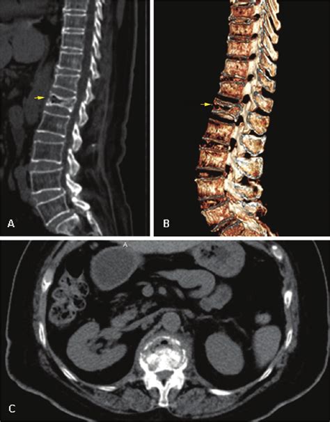 CT scan of the lumbar spine with compression fracture of L1 and ...