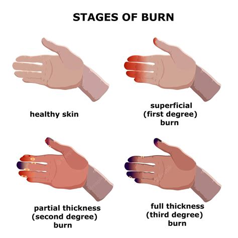 Stages of second degree burn healing - fessspa