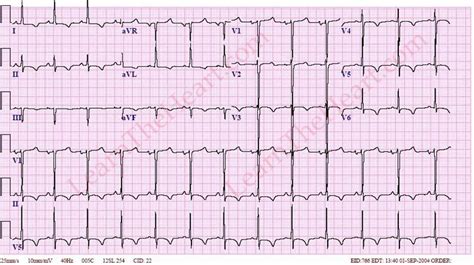 Lv Hypertrophy Ekg | Natural Resource Department