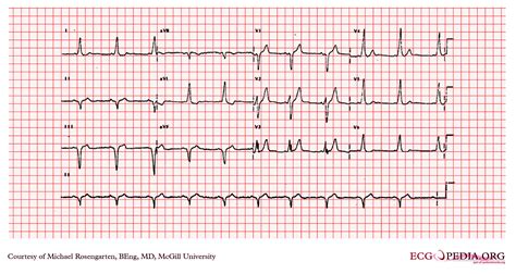 Wolff-Parkinson-White syndrome EKG examples - wikidoc