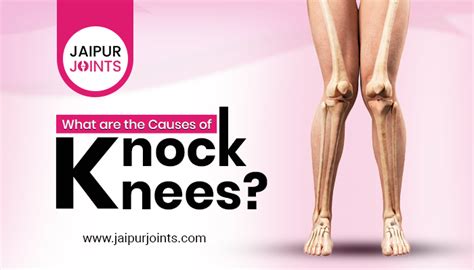 What are the Causes of Knock Knees? | JaipurJoints