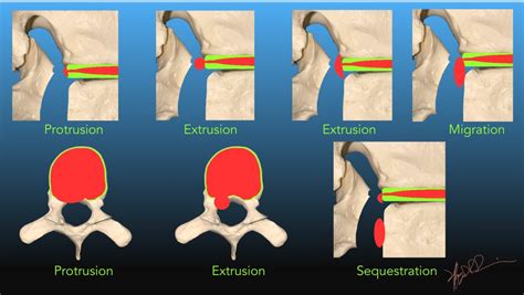 Nomenclature for Intervertebral Disc Herniation | UW Emergency Radiology