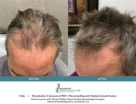 Hair Loss Treatment | Advanced Dermatology Care | Los Alamitos, CA