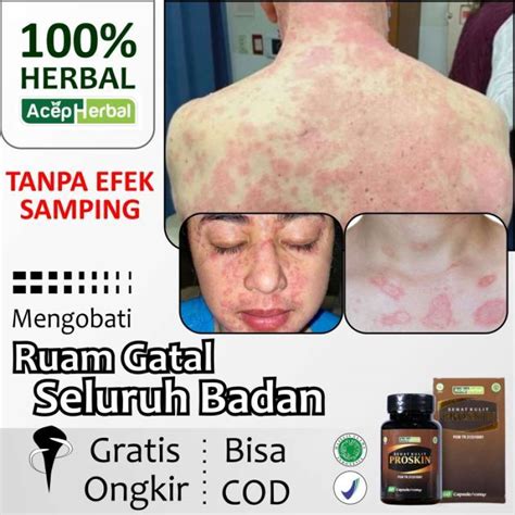 Promo Obat Ruam Kulit Gatal Gatal Seluruh Badan Bentol Bintik Merah ...