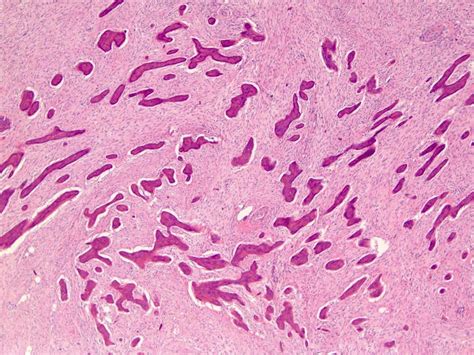 Osteosarcoma Histology