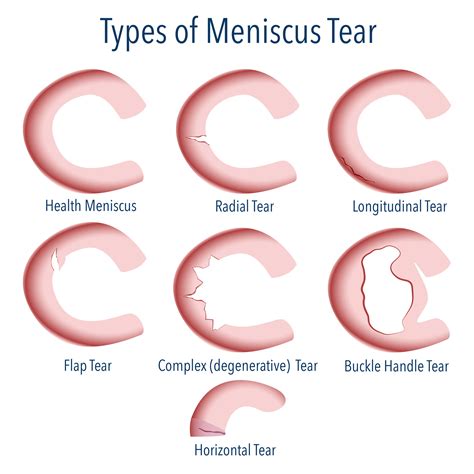 Torn Meniscus Injury Treatment | Knee Meniscus Repair Surgery