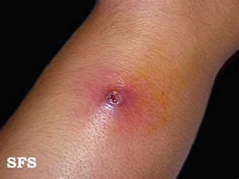 Impetigo Skin Infection Causes, Pictures, Treatment | Healthhype.com