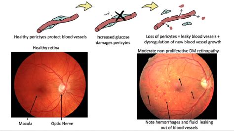 Diabetic Eye Exam - SeeRite Eye Clinic - North York Toronto