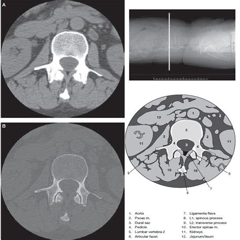 Lumbar Spine - Ct Scan - RadTechOnDuty