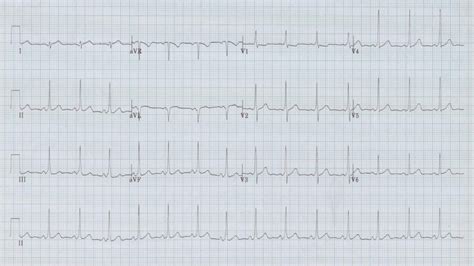 EKG Examples | Torrey EKG