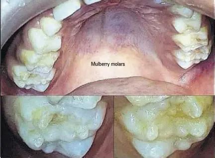 What are mulberry MOLARS? - PressReader